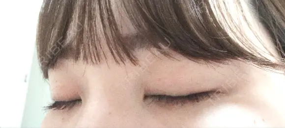 二重埋没 / 上まぶたの脂肪取り TCB東京中央美容外科 江坂院 DAY 112 メイン用