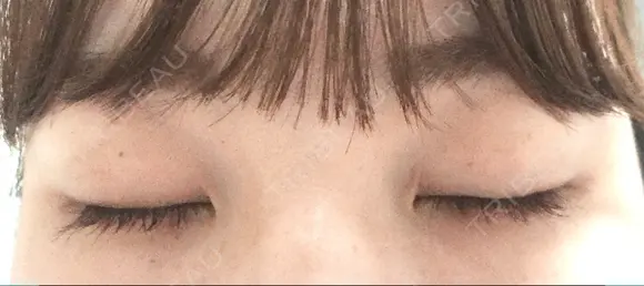二重埋没 / 上まぶたの脂肪取り TCB東京中央美容外科 江坂院 DAY 112 メイン用