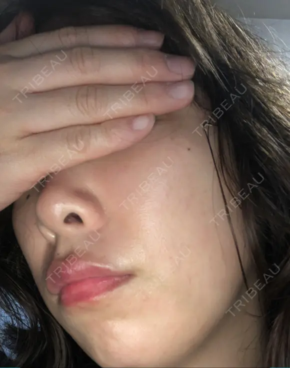 ピーリング（ニキビ・毛穴） 自由が丘クリニック AFTER メイン用