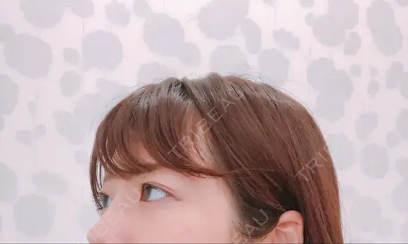 脂肪溶解注射（まぶた） 銀座フェイスクリニック（小顔整形・輪郭整形專門） DAY 14 メイン用