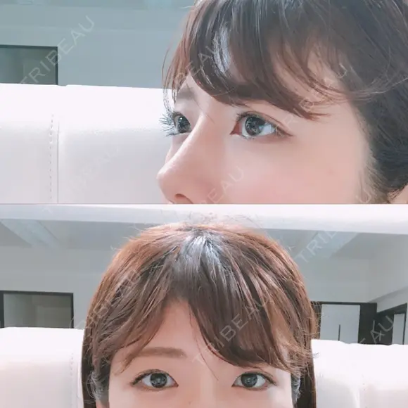 脂肪溶解注射（まぶた） 銀座フェイスクリニック（小顔整形・輪郭整形專門） DAY 25 メイン用