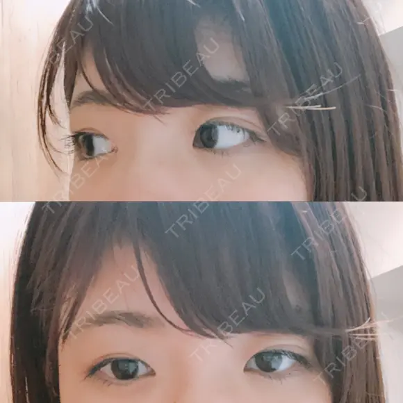 脂肪溶解注射（まぶた） 銀座フェイスクリニック（小顔整形・輪郭整形專門） DAY 27 メイン用