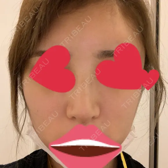 鼻尖形成（切開） / 鼻中隔延長（切開） / バッカルファット除去 / 軟骨移植 / 脂肪注入（額） / 鼻翼基部形成（貴族手術） Zetith Beauty Clinic 銀座院 DAY 8 メイン用