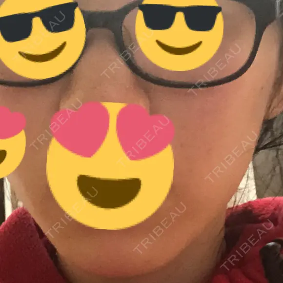 糸リフト 品川スキンクリニック京都院 DAY 0 メイン用