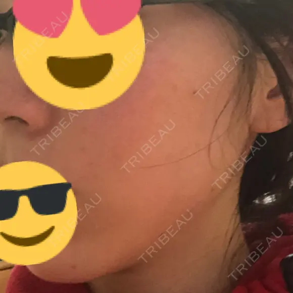 糸リフト 品川スキンクリニック京都院 DAY 0 メイン用