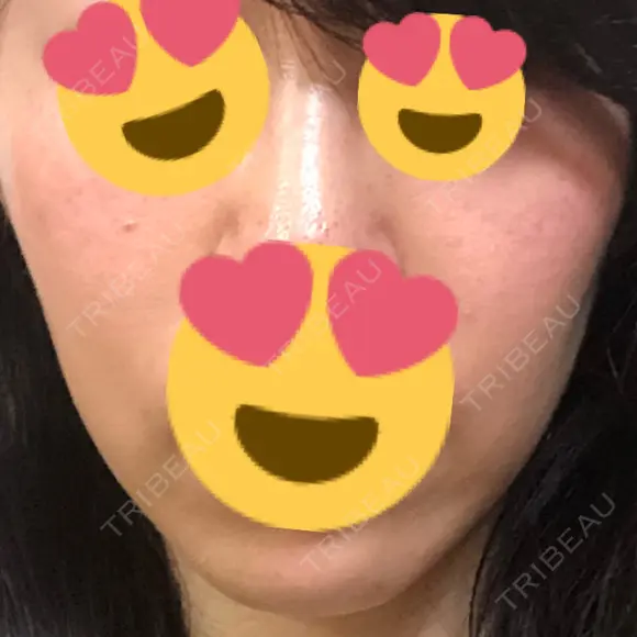 糸リフト 品川スキンクリニック京都院 AFTER メイン用