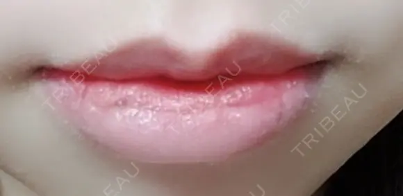 口唇縮小術 B-LINE CLINIC 池袋院 DAY 8 メイン用