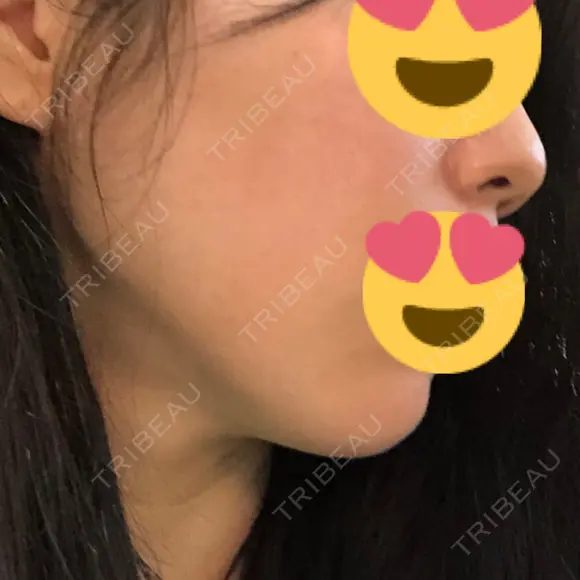 糸リフト 品川スキンクリニック京都院 DAY 49 メイン用