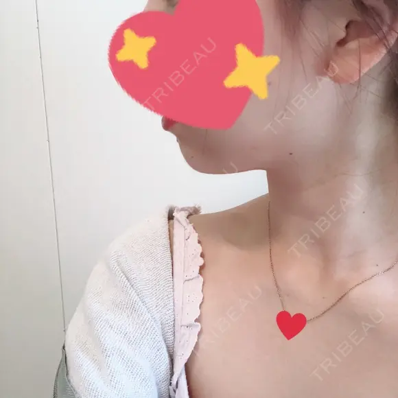 ヒアルロン酸注入（あご） ヴェリテクリニック 大阪院 DAY 15 メイン用