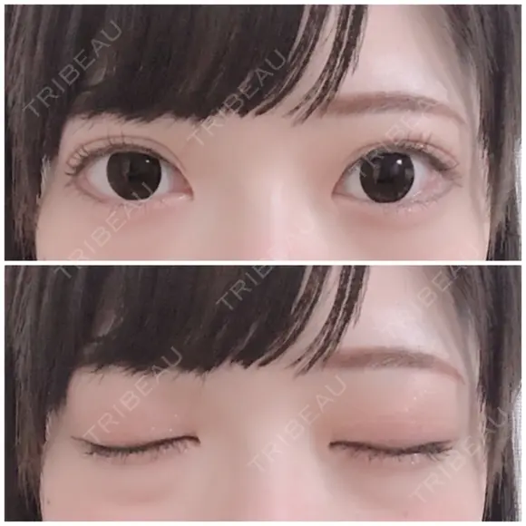 二重切開 / 上まぶたたるみ取り / 上まぶたの脂肪取り 銀座高須クリニック DAY 124 メイン用