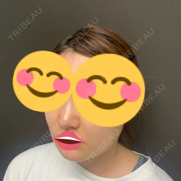 鼻尖形成（切開） / 小鼻縮小（切開） / 脂肪吸引（顔） / 真皮移植 ジョウクリニック 姫路院 DAY 45 メイン用