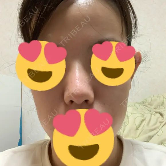 鼻尖形成（切開） / ヒアルロン酸注入（鼻） 東京ヒルズクリニック 新宿院 DAY 27 メイン用