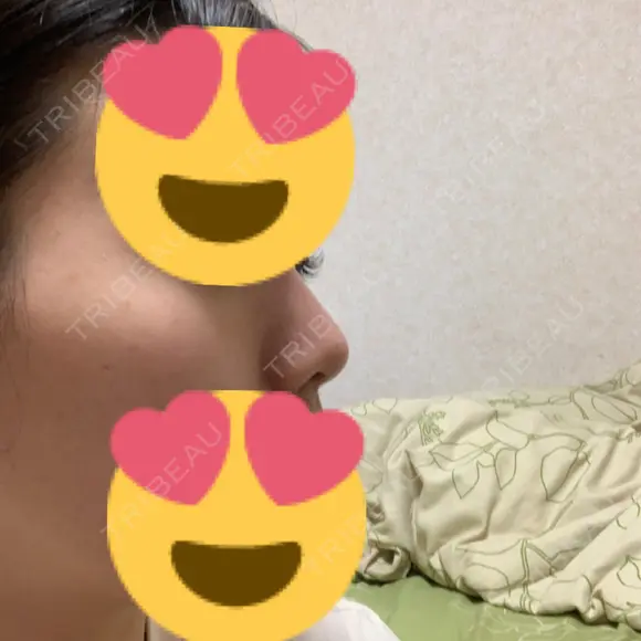 鼻尖形成（切開） / ヒアルロン酸注入（鼻） 東京ヒルズクリニック 新宿院 DAY 27 メイン用