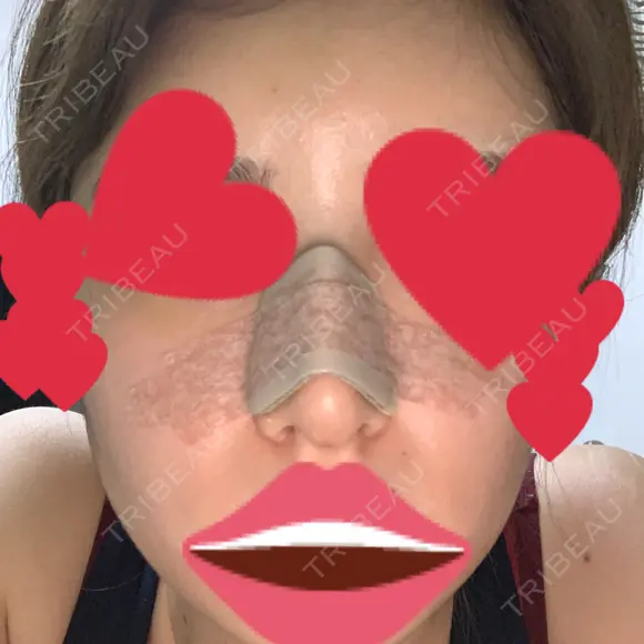 鼻尖形成（切開） / 鼻中隔延長（切開） / バッカルファット除去 / 軟骨移植 / 脂肪注入（額） / 鼻翼基部形成（貴族手術） Zetith Beauty Clinic 銀座院 DAY 10 メイン用