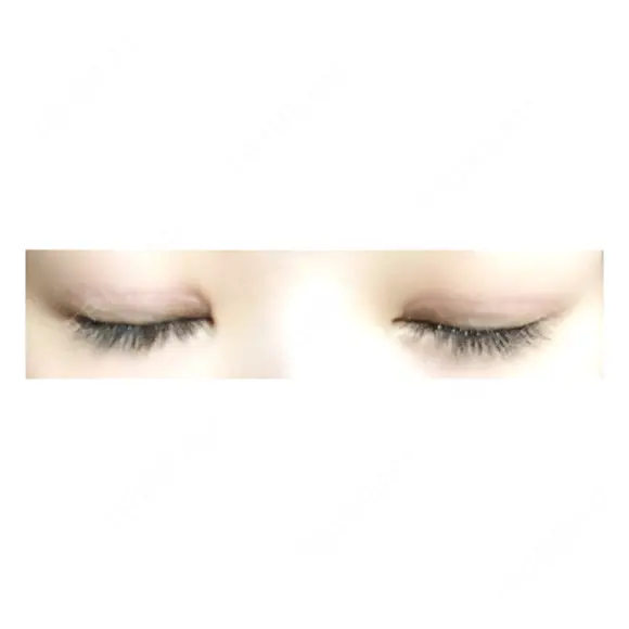 二重切開 神野美容形成外科クリニック DAY 77 メイン用