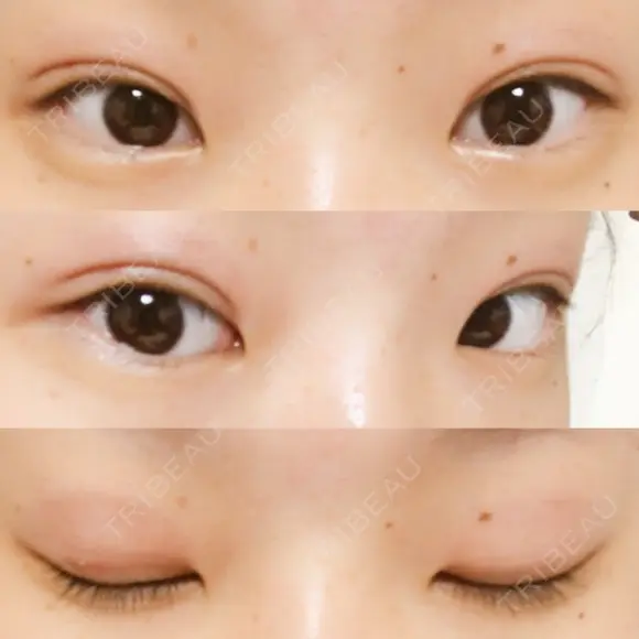 二重埋没 湘南美容クリニック 大阪堺東院 DAY 18 メイン用