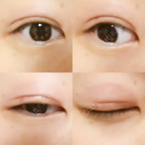 二重埋没 湘南美容クリニック 大阪堺東院 DAY 18 メイン用