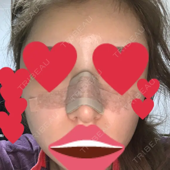 鼻尖形成（切開） / 鼻中隔延長（切開） / バッカルファット除去 / 軟骨移植 / 脂肪注入（額） / 鼻翼基部形成（貴族手術） Zetith Beauty Clinic 銀座院 AFTER メイン用