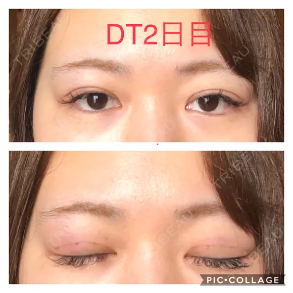 二重埋没 城本クリニック 四日市院 DAY 2 メイン用