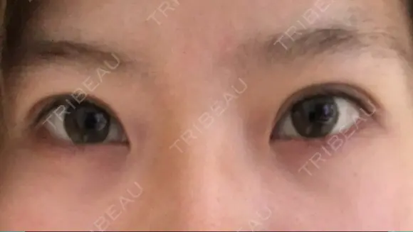 眼瞼下垂（切開） 芦屋美容クリニック 芦屋院 AFTER メイン用