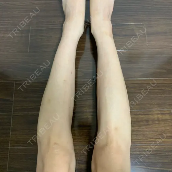 ボトックス（ふくらはぎ） TCB東京中央美容外科 中野院 DAY 1 メイン用