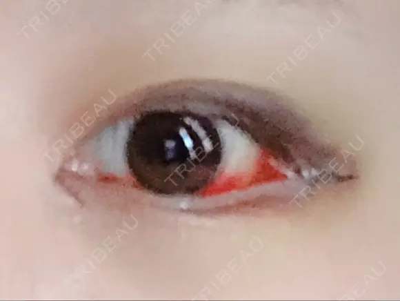 目頭切開 / 目尻切開 FROM B整形外科 (旧バウム整形外科) DAY 4 メイン用