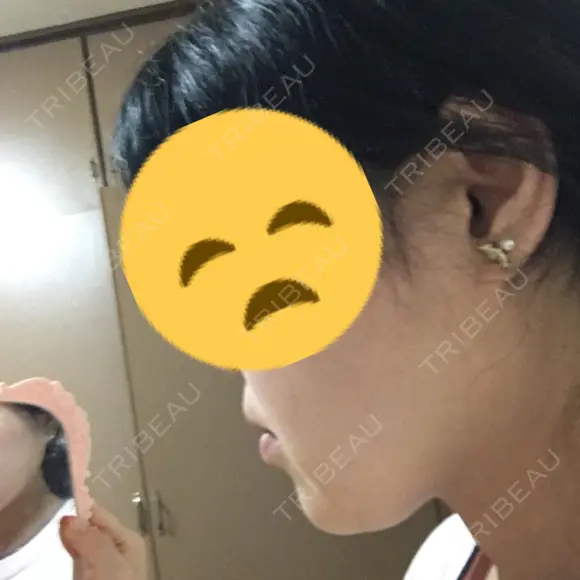 その他（輪郭） 品川美容外科 静岡院 DAY 35 メイン用