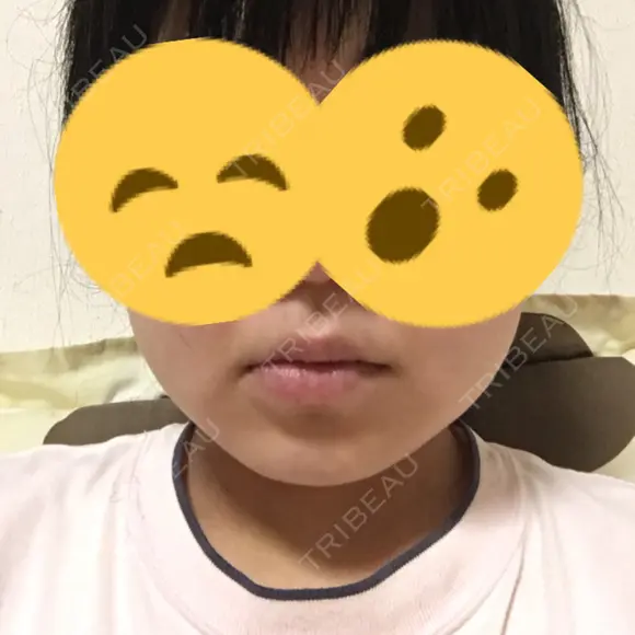 その他（輪郭） 品川美容外科 静岡院 DAY 35 メイン用