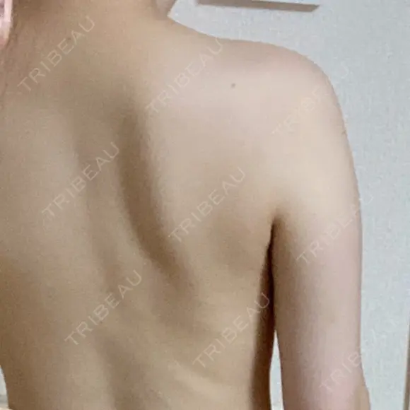 GLP-1ダイエット / 脂肪溶解注射（二の腕） / その他（ボディ） 湘南美容クリニック 新橋銀座口院 DAY 9 メイン用
