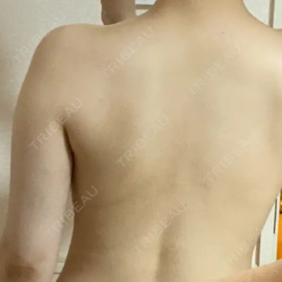 GLP-1ダイエット / 脂肪溶解注射（二の腕） / その他（ボディ） 湘南美容クリニック 新橋銀座口院 DAY 9 メイン用