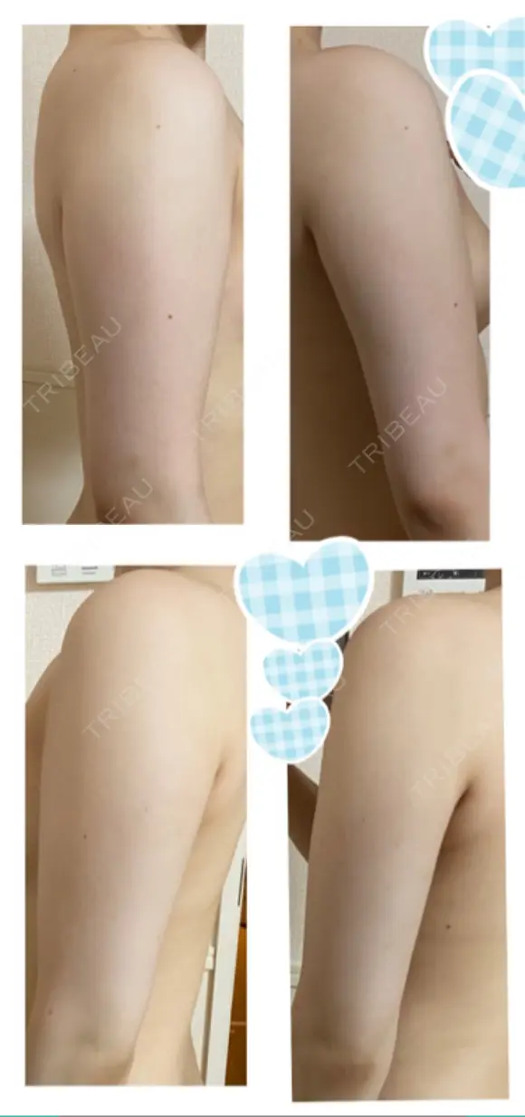 GLP-1ダイエット / 脂肪溶解注射（二の腕） / その他（ボディ） 湘南美容クリニック 新橋銀座口院 DAY 9 メイン用