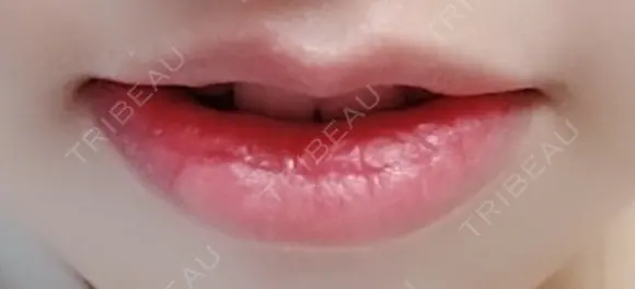 口唇縮小術 B-LINE CLINIC 池袋院 DAY 14 メイン用