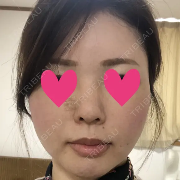 脂肪注入（輪郭） テラクリニック DAY 46 メイン用