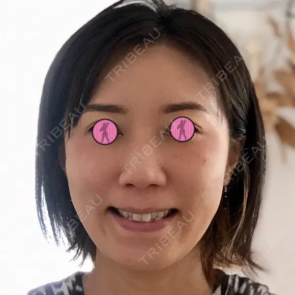 肌ヒアルロン酸注入（たるみ・シワ改善） / ヒアルロン酸注入（頬） 青山外苑前クリニック DAY 2 メイン用