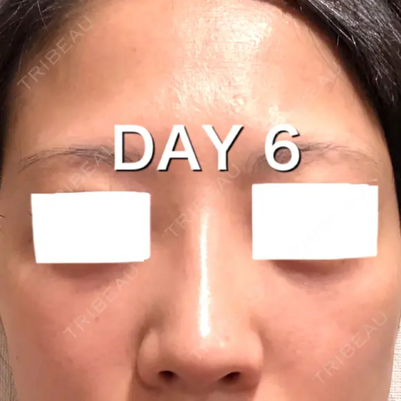 ヒアルロン酸注入（鼻） BIANCA銀座 DAY 6 メイン用