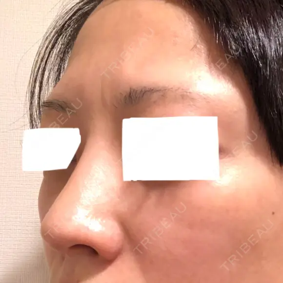 ヒアルロン酸注入（鼻） BIANCA銀座 DAY 6 メイン用