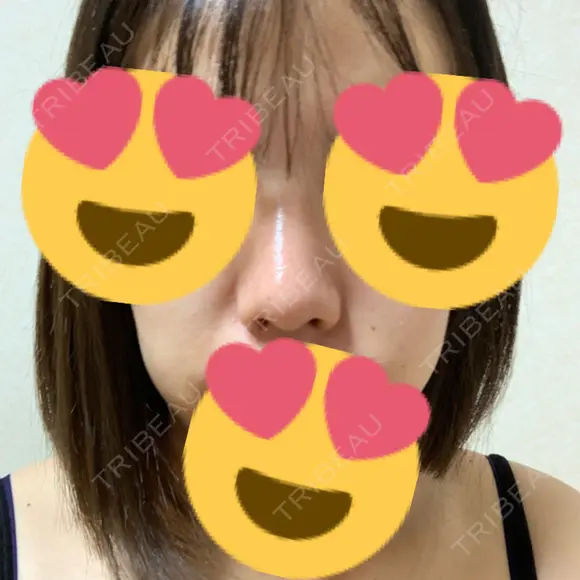 鼻尖形成（切開） / ヒアルロン酸注入（鼻） 東京ヒルズクリニック 新宿院 AFTER メイン用