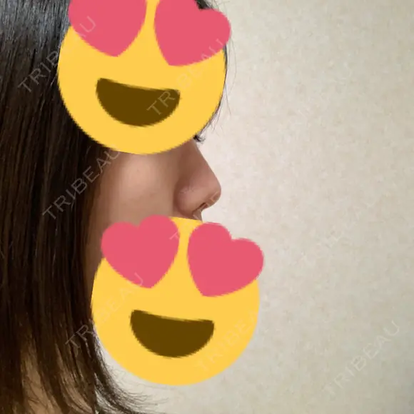 鼻尖形成（切開） / ヒアルロン酸注入（鼻） 東京ヒルズクリニック 新宿院 DAY 33 メイン用