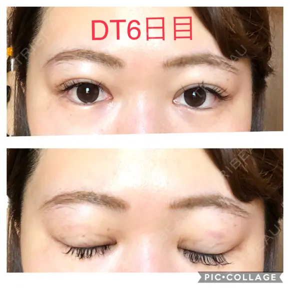 二重埋没 城本クリニック 四日市院 DAY 6 メイン用