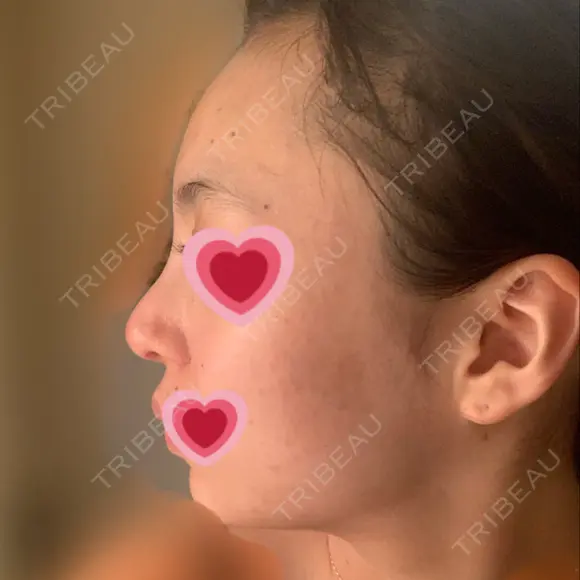 隆鼻術 / 鼻尖形成（切開） / 小鼻縮小（切開） / 軟骨移植 / プロテーゼ除去 / 鼻修正 グローバルビューティークリニック 大阪院 DAY 35 メイン用