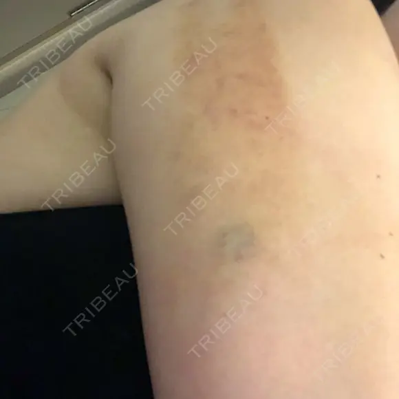 脂肪溶解注射（顔） / 脂肪溶解注射（二の腕） / ボトックス（肩） / その他（ボディ） 品川スキンクリニック京都院 DAY 3 メイン用