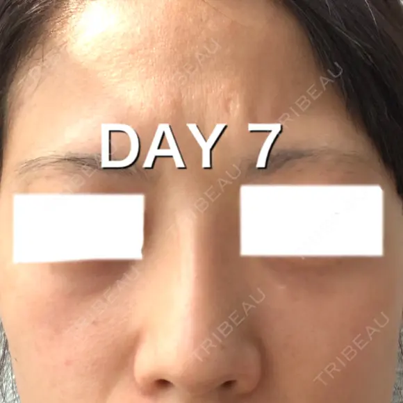ヒアルロン酸注入（鼻） BIANCA銀座 DAY 7 メイン用