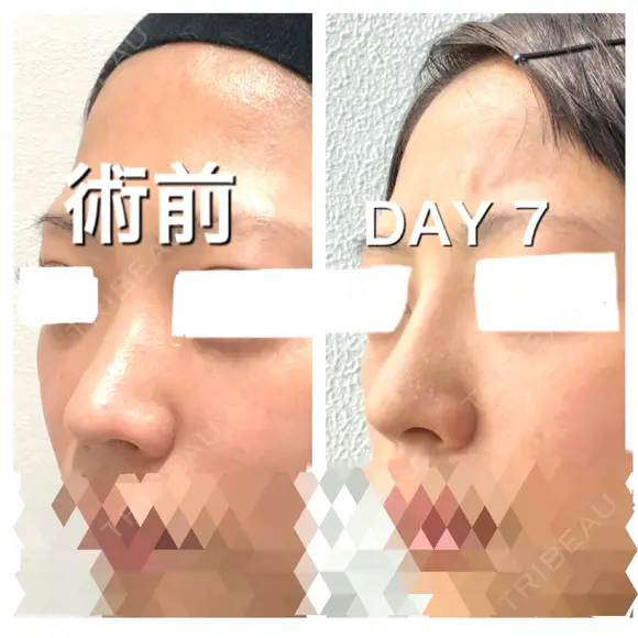 ヒアルロン酸注入（鼻） BIANCA銀座 DAY 7 メイン用