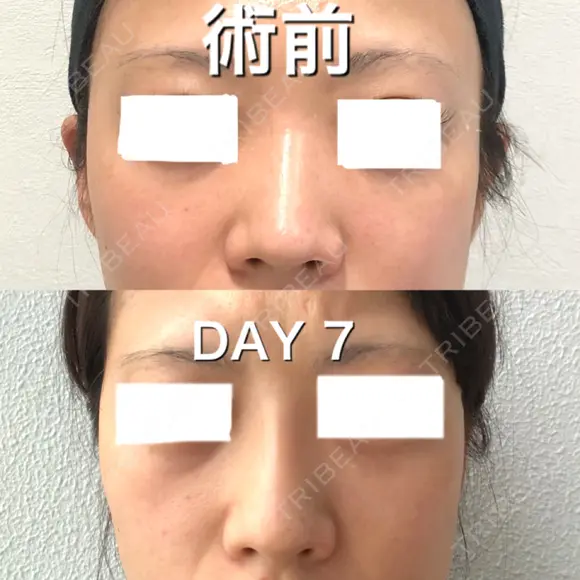 ヒアルロン酸注入（鼻） BIANCA銀座 DAY 7 メイン用