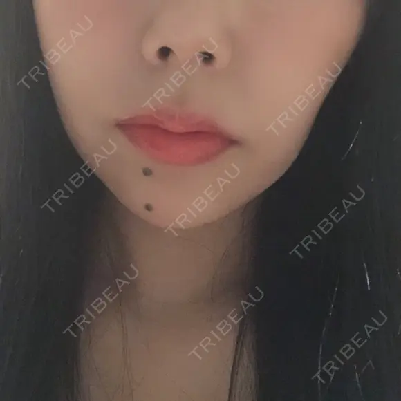 ヒアルロン酸注入（唇） / ボトックス（口角） id美容クリニック 銀座院 DAY 0 メイン用