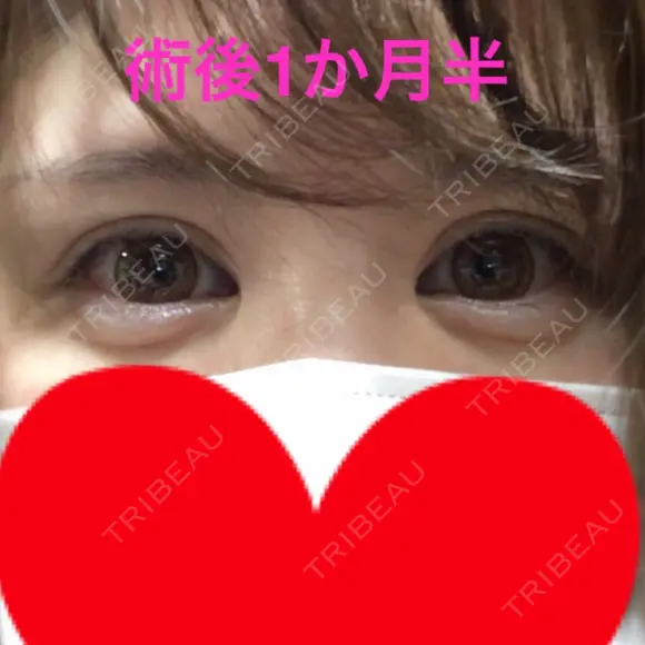 二重埋没 / 上まぶたの脂肪取り 東京ヒルズクリニック 新宿院 DAY 45 メイン用