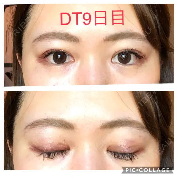 二重埋没 城本クリニック 四日市院 DAY 9 メイン用