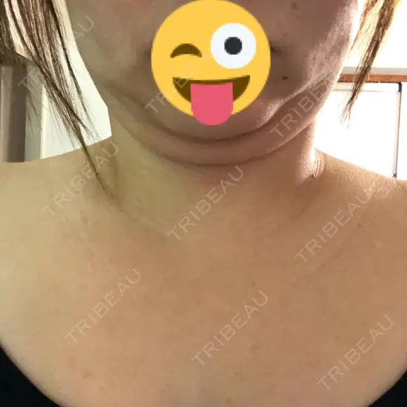 脂肪溶解注射（顔） / 脂肪溶解注射（二の腕） / ボトックス（肩） / その他（ボディ） 品川スキンクリニック京都院 DAY 5 メイン用