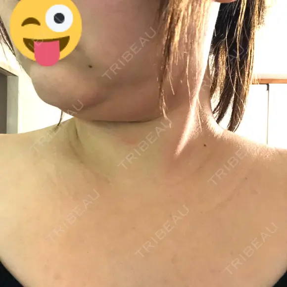 脂肪溶解注射（顔） / 脂肪溶解注射（二の腕） / ボトックス（肩） / その他（ボディ） 品川スキンクリニック京都院 DAY 5 メイン用