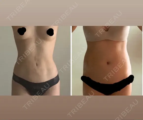 脂肪吸引（お腹） WOM CLINIC GINZA （ワム クリニック ギンザ） DAY 42 メイン用